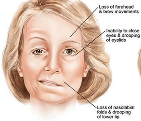 what is bell palsy caused from